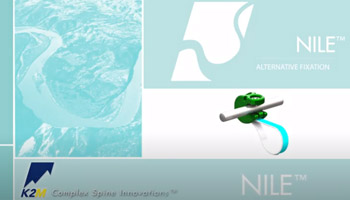 NILE Alternative Fixation Surgical Technique Animation