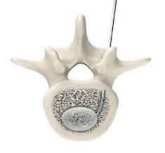 Vertebral Compression Fractures Products