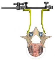 Xia CT (Cortical Trajectory) Product