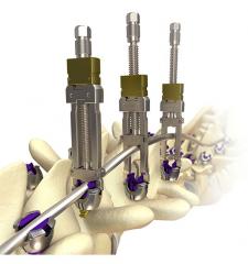 MESA® 2 Deformity Spinal System Product