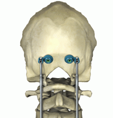 CASPIAN® Occipital Anchor Spinal System Product