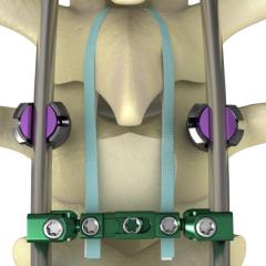 NILE® Proximal Fixation Spinal System Product