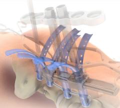 SERENGETI® Complex Minimally Invasive Retractor System Product