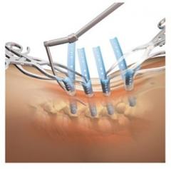 SERENGETI® Minimally Invasive Retractor System Product