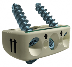 CHESAPEAKE® Anterior-Lumbar Stabilization System