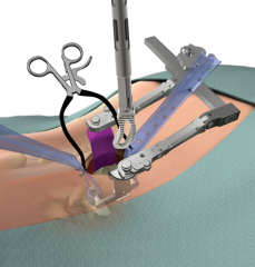 TERRA NOVA® Minimally Invasive Access System