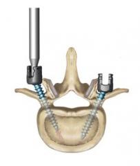 DENALI® Degenerative Spinal System Product