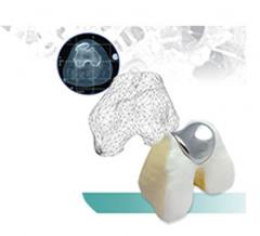 KineMatch PFR - Custom Patellofemoral Replacement