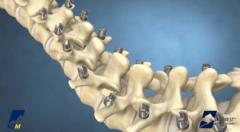 EVEREST® Deformity Spinal System Product